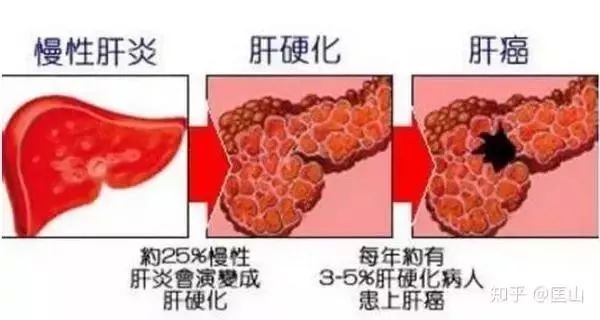 肝硬化最新治疗方法，探索与创新实践